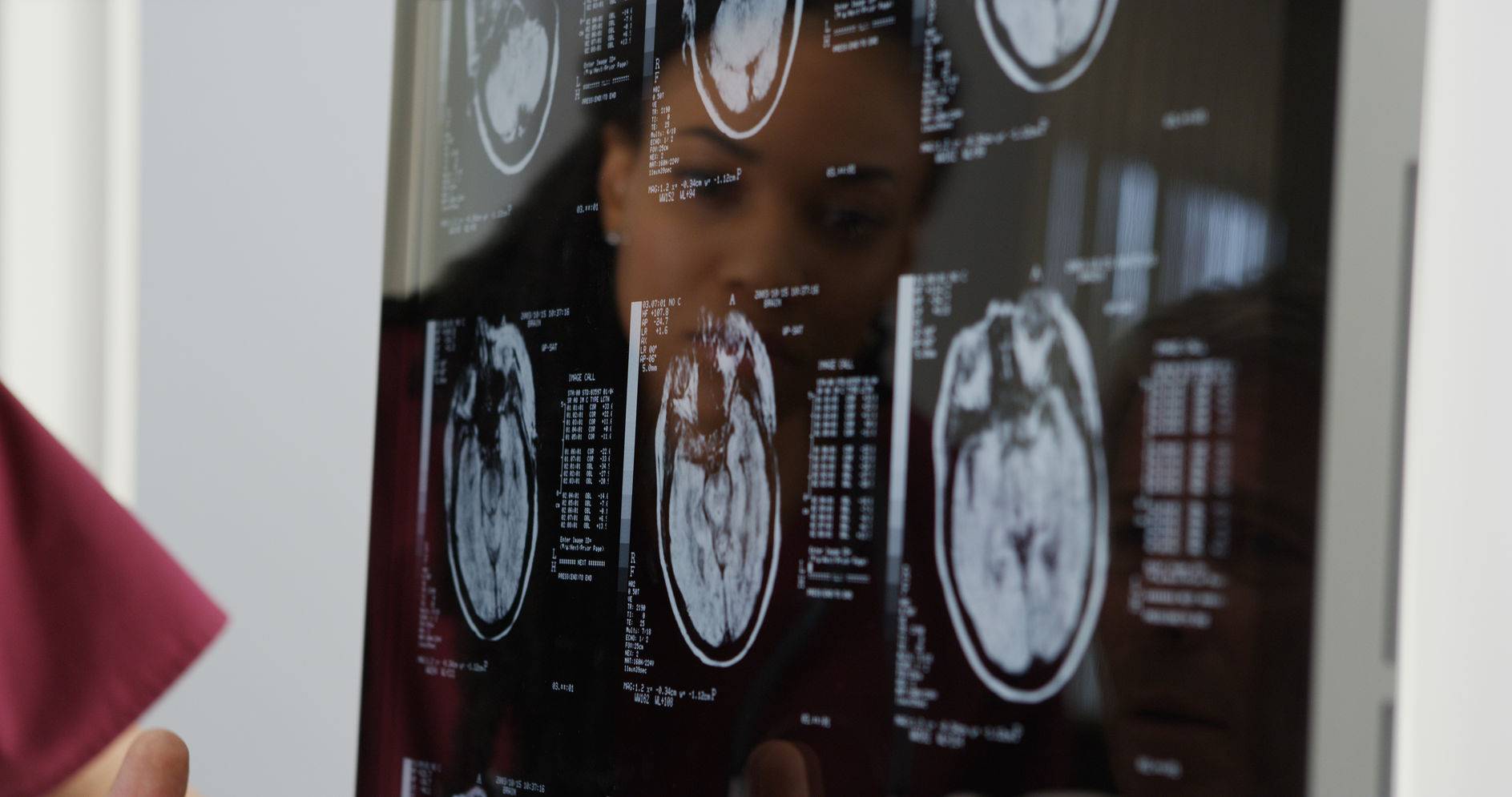 Management and Treatment with Gamma Knife ICON