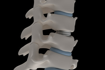 Cervical Disc Replacement: What to Expect