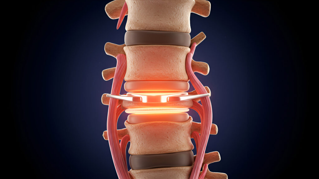 Medical illustration comparing Artificial Disc Replacement vs spinal fusion, showing a spinal disc implant placed between vertebrae to support motion and relieve disc-related pain.