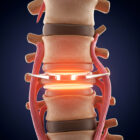 Medical illustration comparing Artificial Disc Replacement vs spinal fusion, showing a spinal disc implant placed between vertebrae to support motion and relieve disc-related pain.