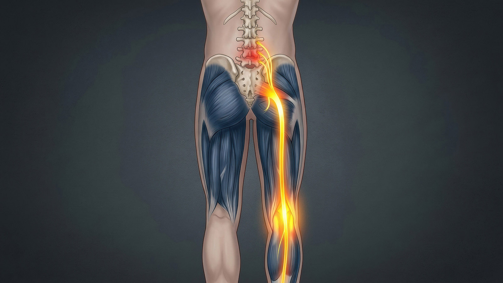 Lumbar Radiculopathy: What It Is, What Causes It, and What to Do