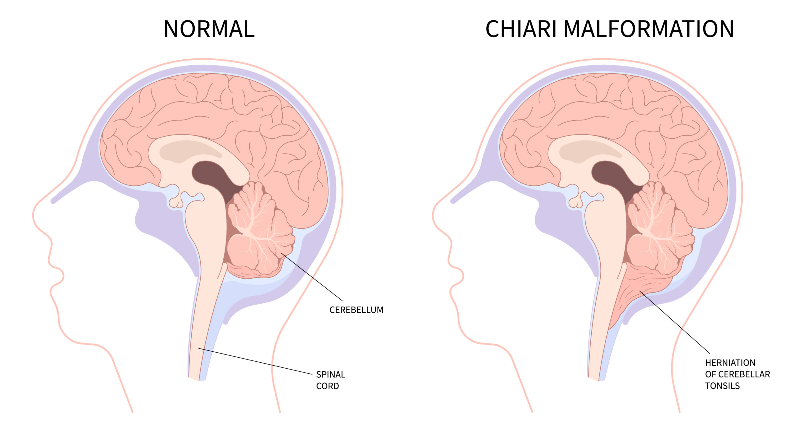 Side-by-side illustration comparing normal brain anatomy with Chiari malformation, showing the cerebellar tonsils extending into the spinal canal.