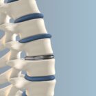 Artificial Disk replacement in the lumbar spine