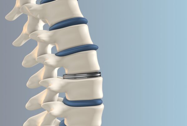 Artificial Disk replacement in the lumbar spine