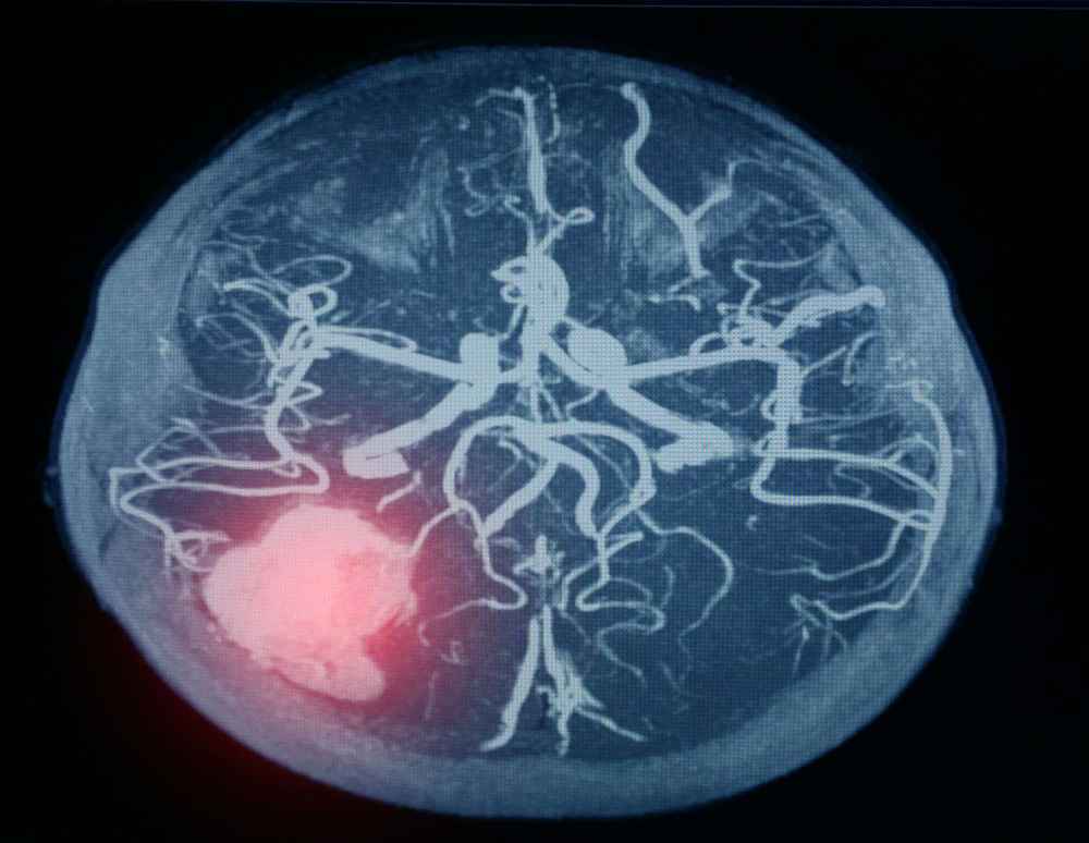Brain Aneurysm Recovery: What to Know