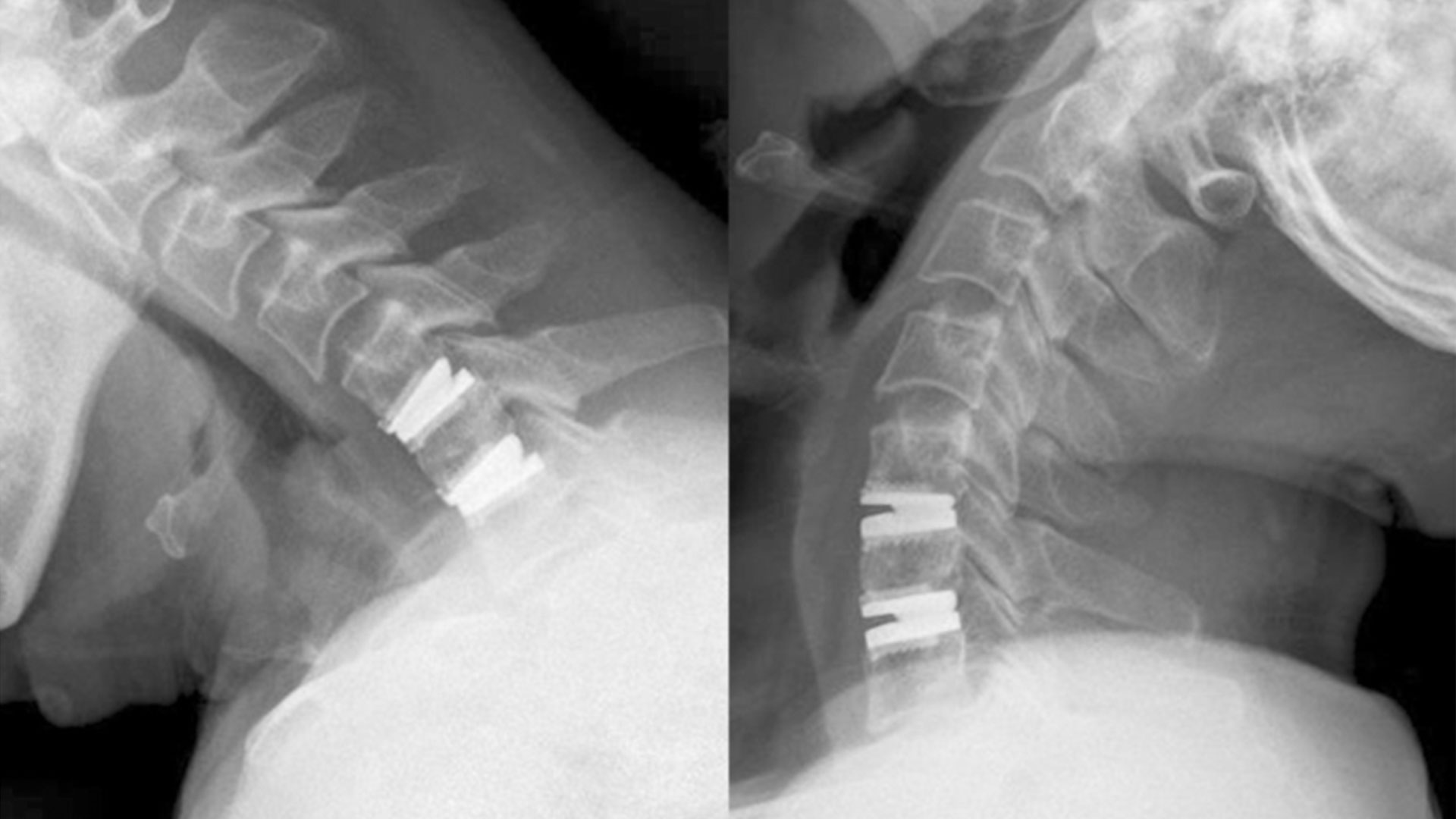 Cervical Disc Replacement vs Fusion: Understanding Your Options for Spinal Health