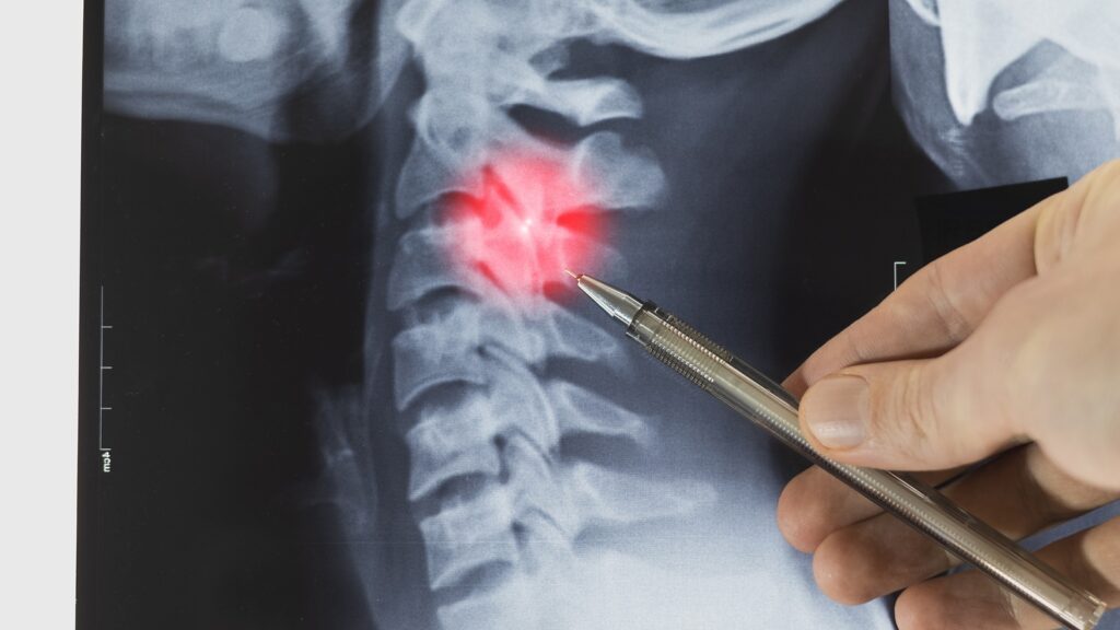Doctor highlighting an X-ray of a pinched nerve.