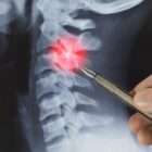 Doctor highlighting an X-ray of a pinched nerve.