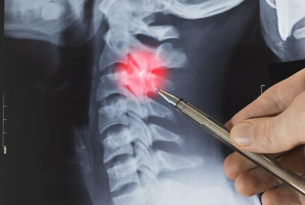 Doctor highlighting an X-ray of a pinched nerve.