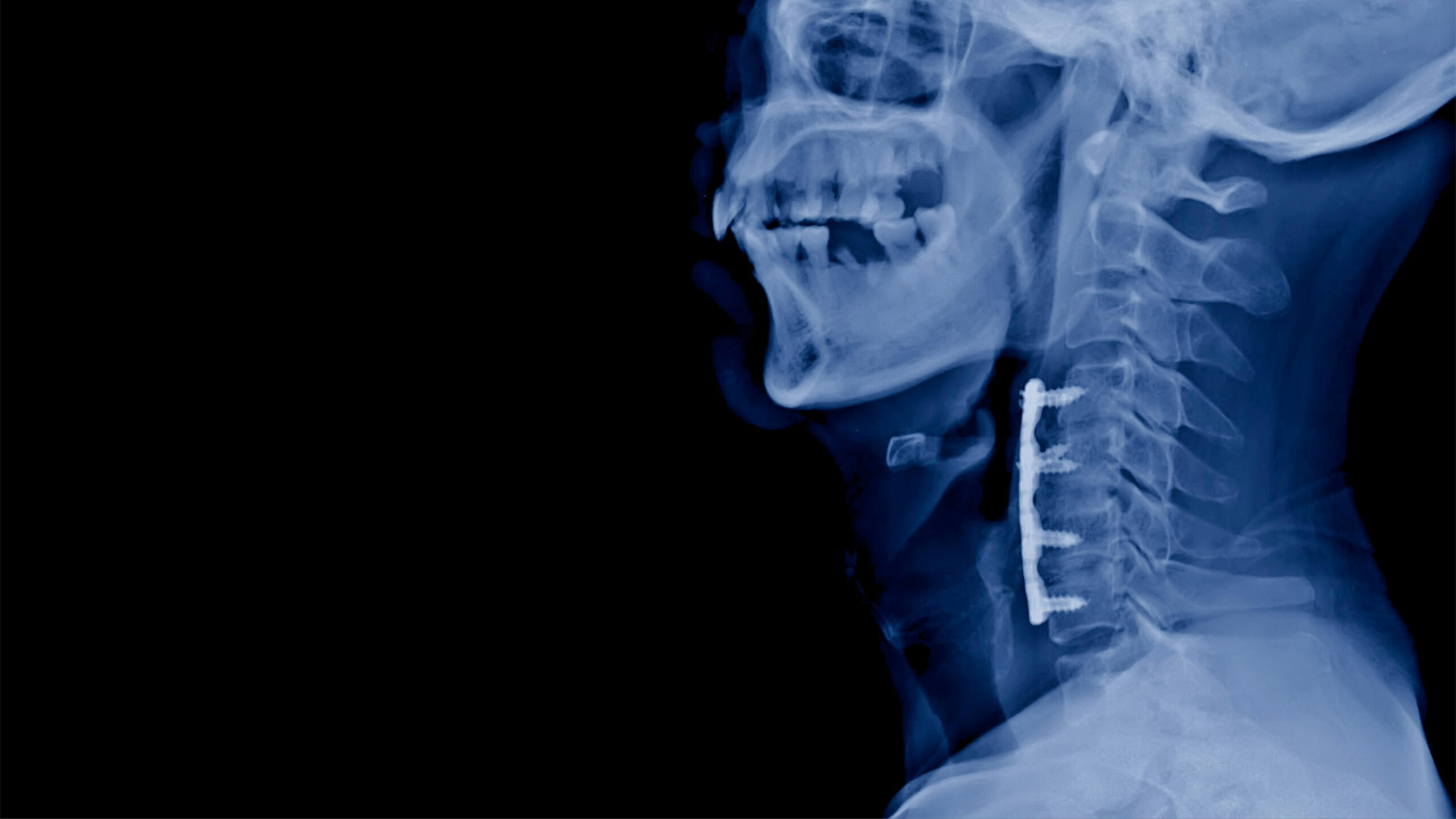 Cervical Discectomy Surgery IMAGE 1 Neurosurgeons Of New Jersey cervical-discectomy-surgery-image-1-neurosurgeons-of-new-jersey