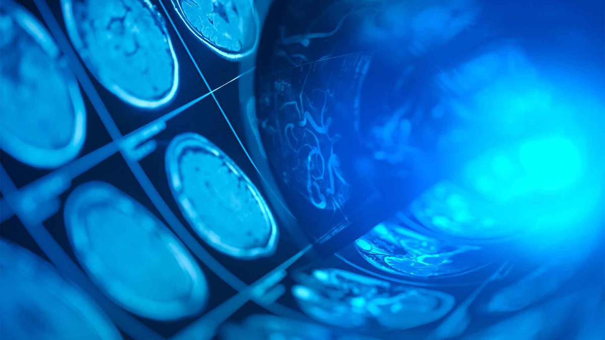 Understanding a Novel Treatment for Chronic Subdural Hematoma: MMA Embolization Explained