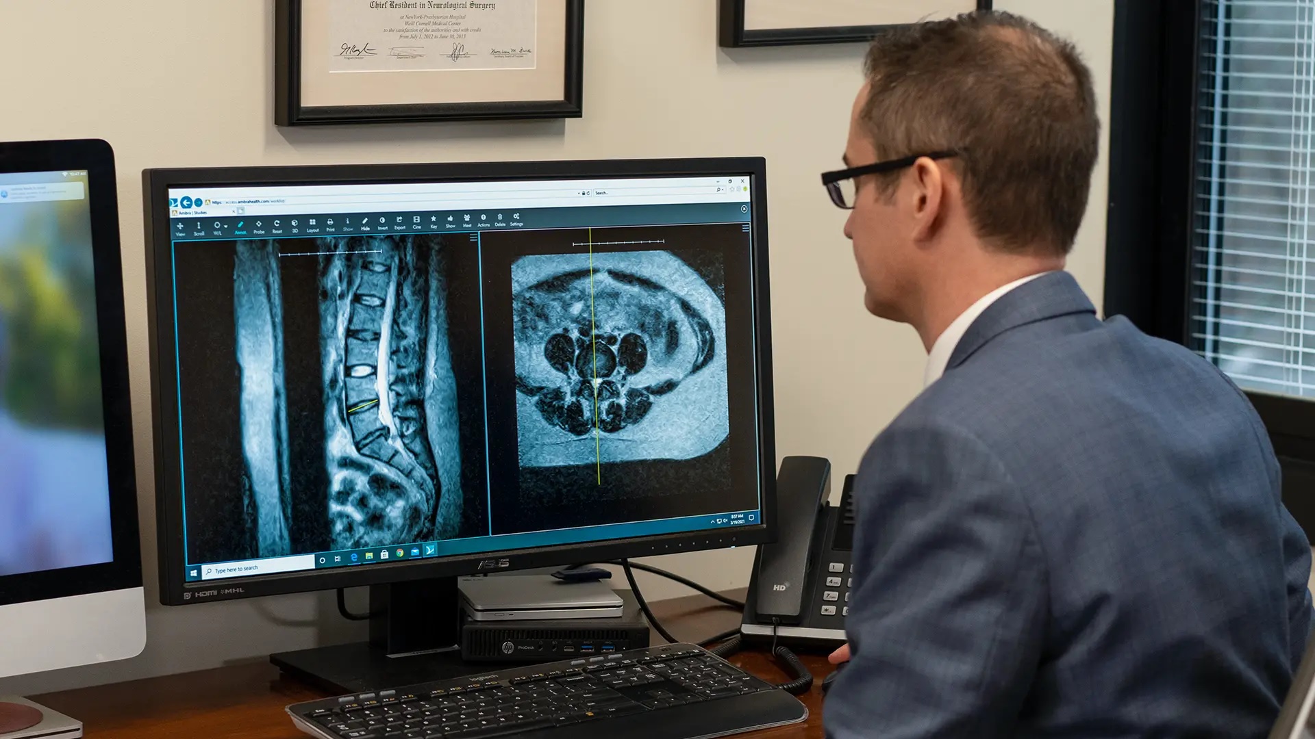 Treatment of radicular leg pain with lumbar foraminotomy