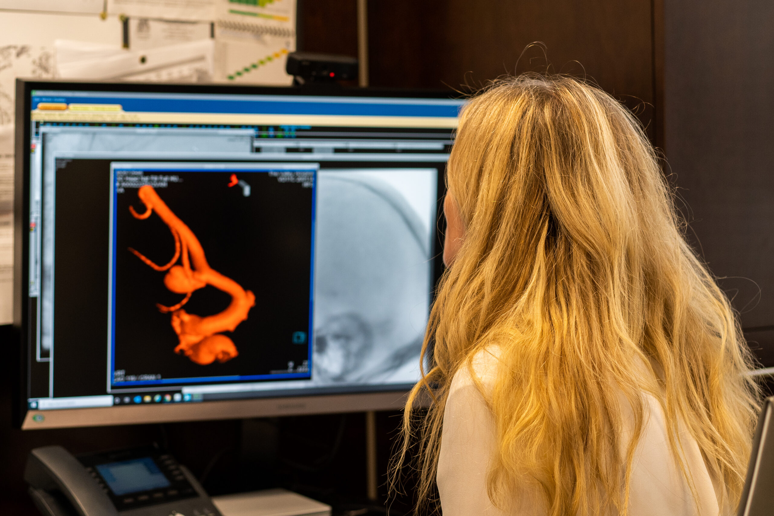 Lumbar puncture for Idiopathic Intracranial Hypertension