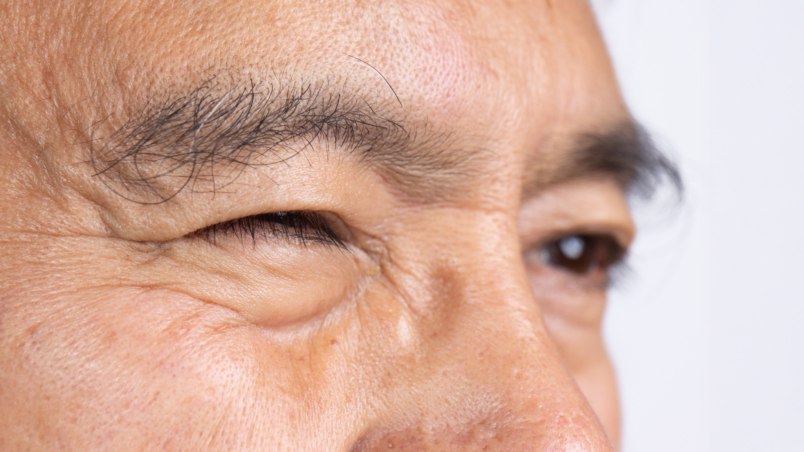Hemifacial Spasm vs. Bell’s Palsy: What’s the Difference?