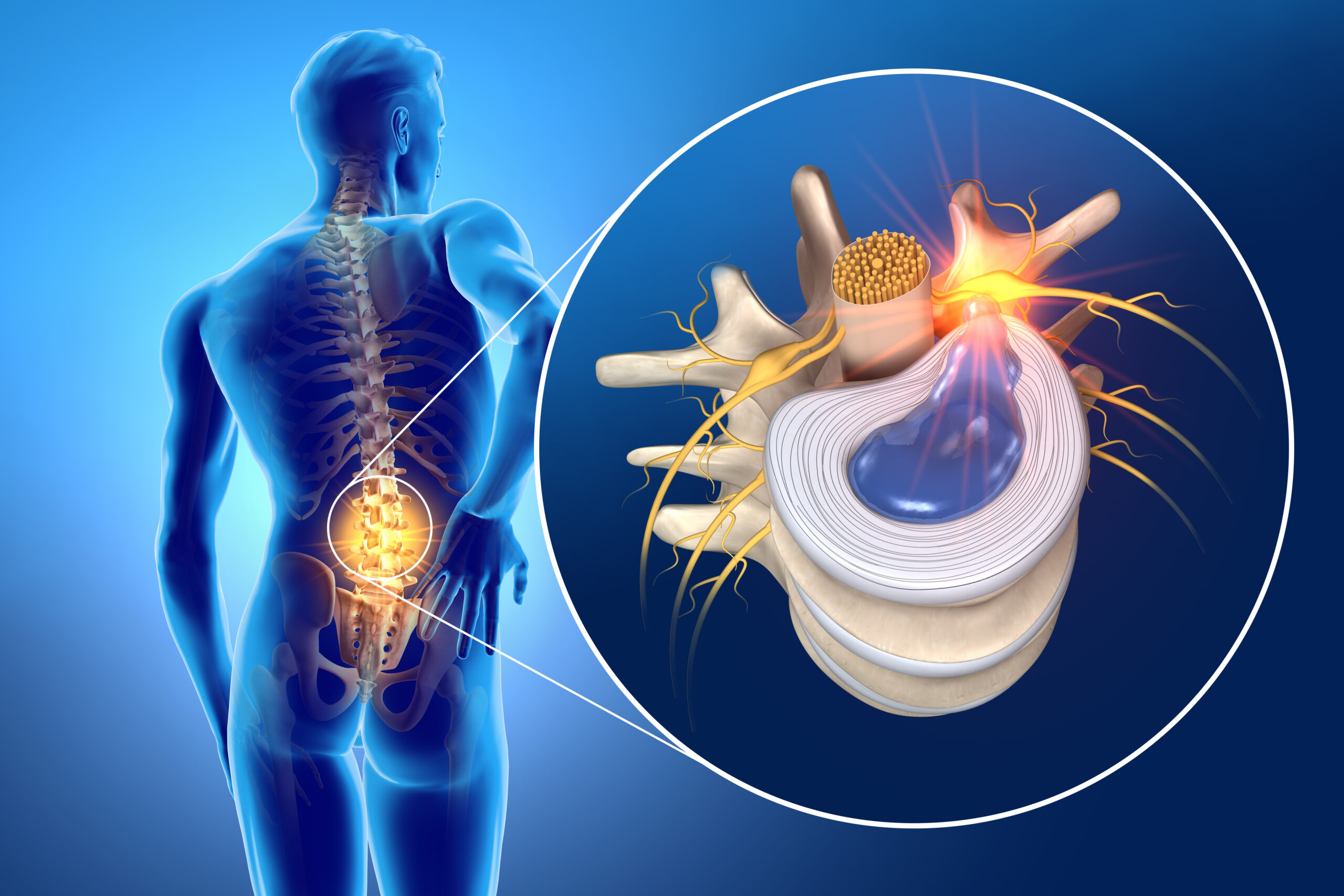 Understanding Herniated Disc: An Overview