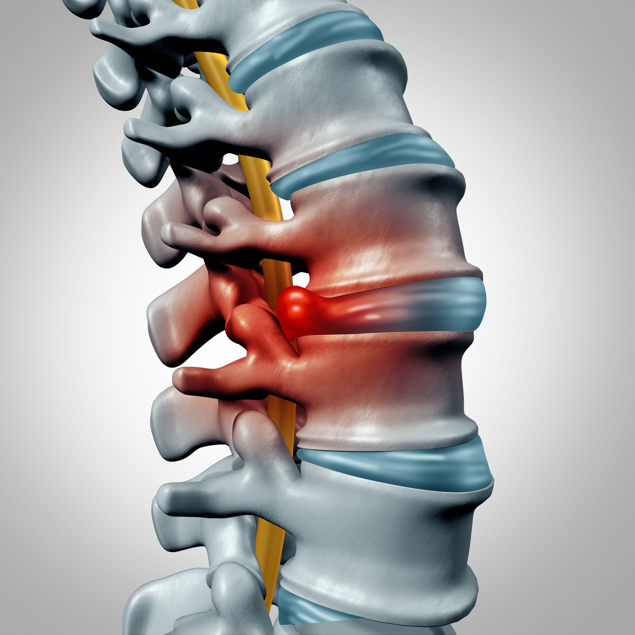 Herniated Disc Treatment Options Explained