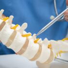 Doctor holding spinal nerve and bone model, Lumbar spine displaced herniated disc.