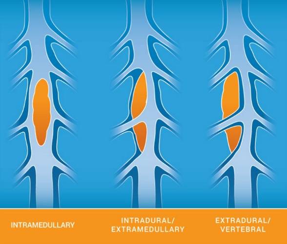 intradural extramedullary tumors