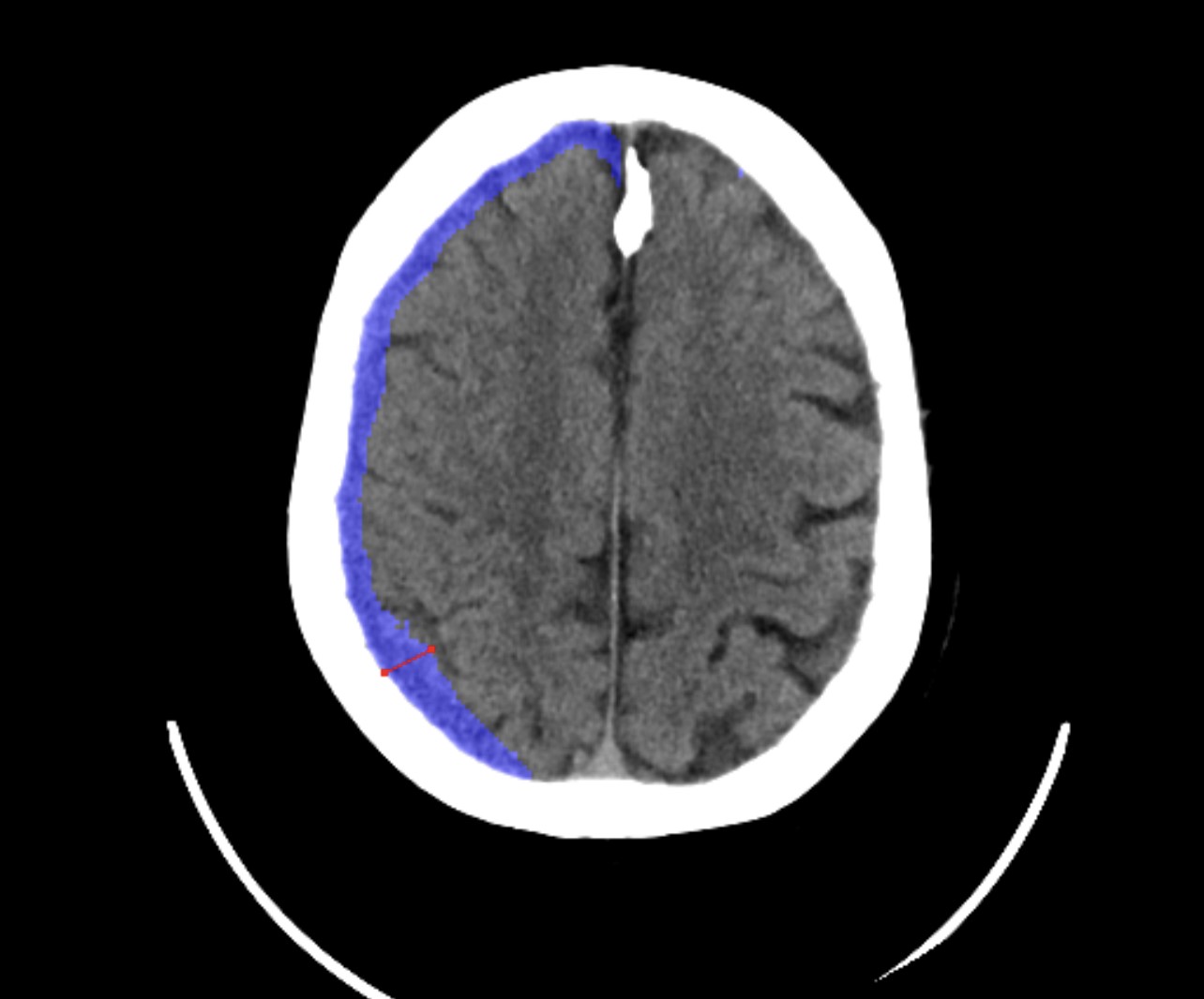 Subdural hematoma surgery – What you should know