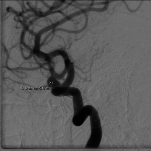 Cerebral aneurysm as viewed by a conventional catheter angiogram.