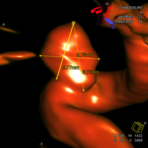 3D view of cerebral aneurysm obtained by a rotational angiogram