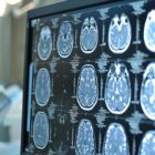 Brain MRI scans displayed on a monitor in a medical imaging room.