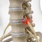 Anatomical visualization of cervical radiculopathy.