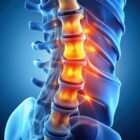 Illuminated 3D model of a lumbar spine showing a herniated disc fragment compressing a spinal nerve, surrounded by vertebrae.