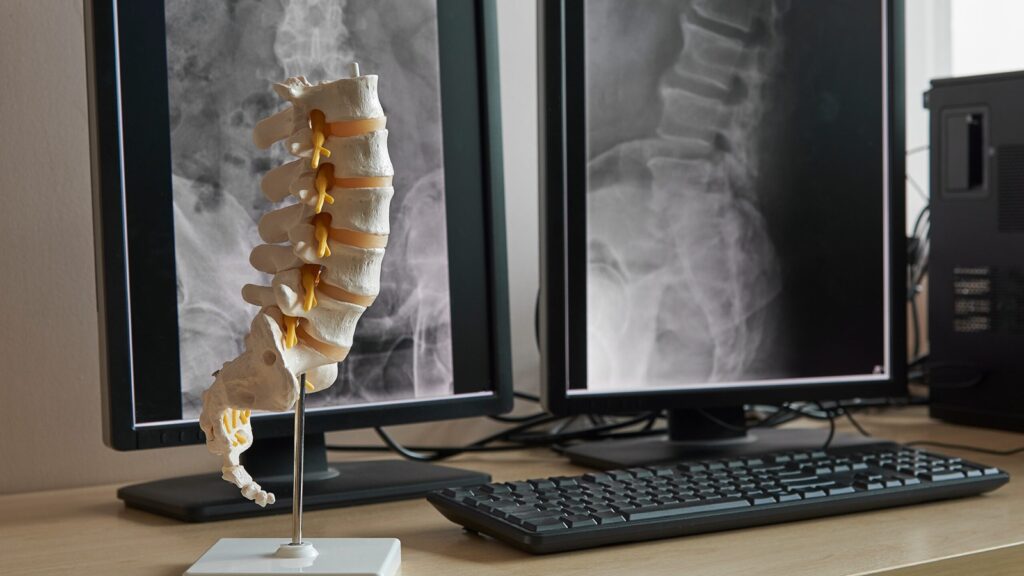 Human lumbar spine model and background of x-rays lumbar spine