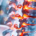 Zoomed-in illustration of inflamed lumbar spinal discs