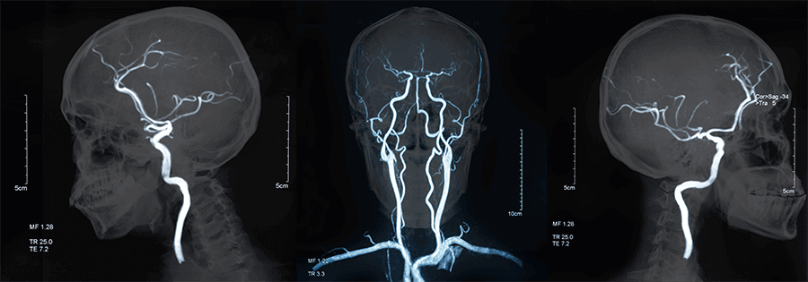 A brain angiogram