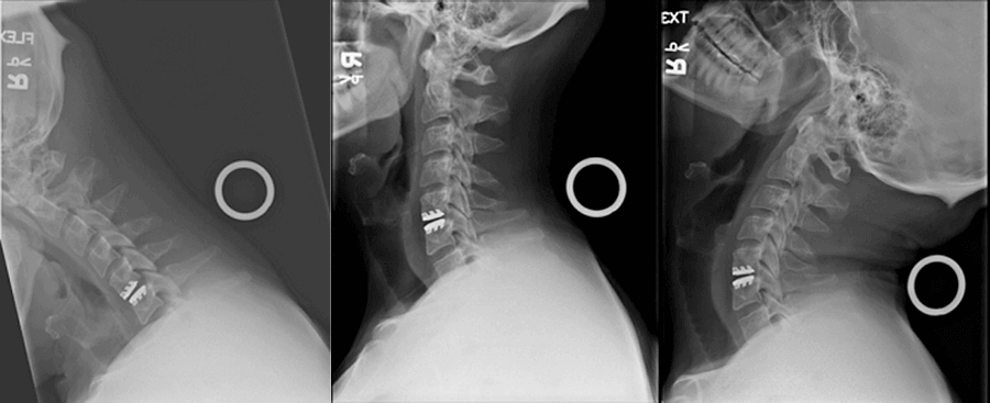 After Artificial Cervical Disc Surgery