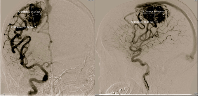 Arteriovenous Malformation of the Brain