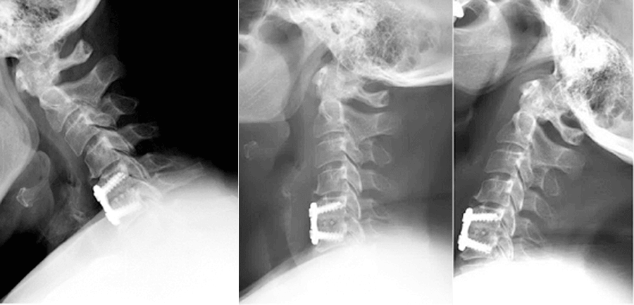 Artificial Cervical Disc Surgery