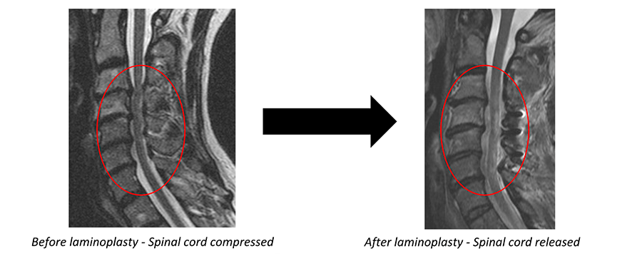 X-ray before and after laminoplasty