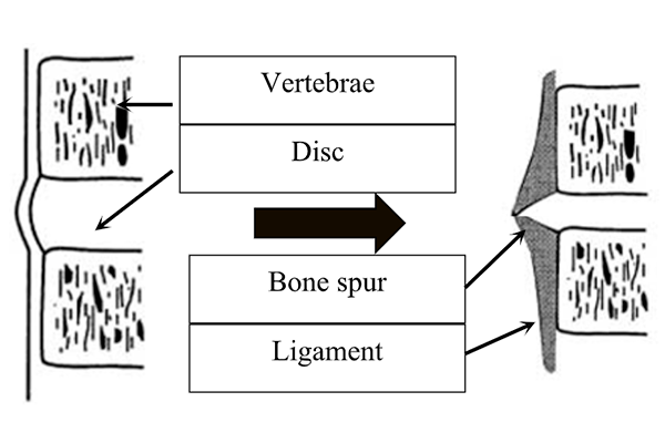 Bone spur formation