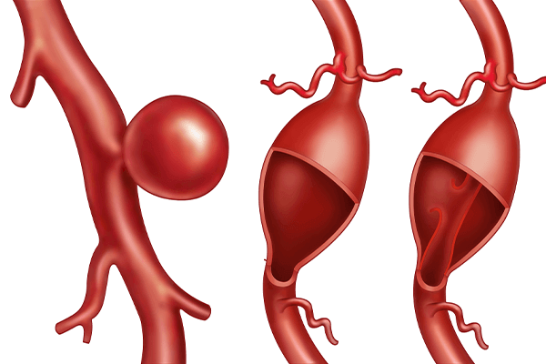 Brain aneurysm blood vessels