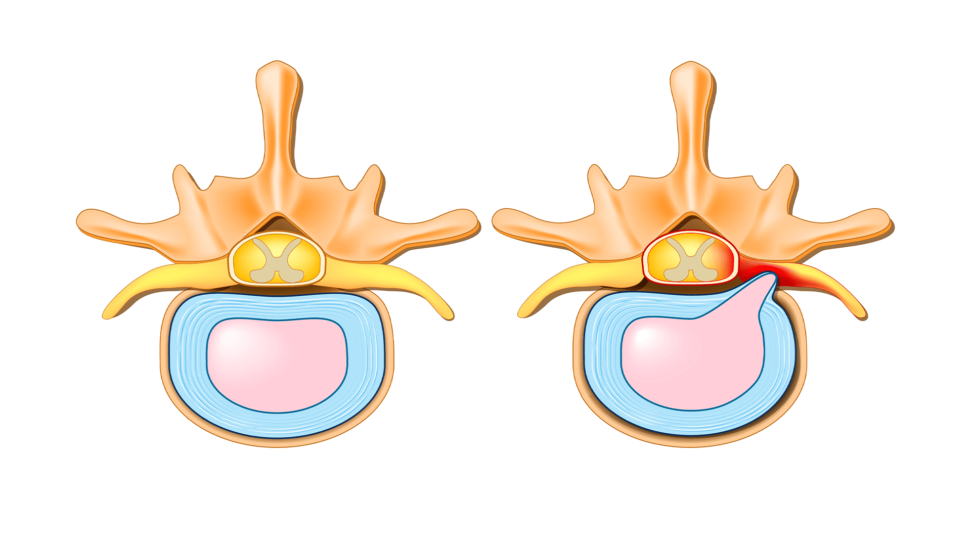 Cervical Foraminal Stenosis – Causes, Symptoms, and Treatment