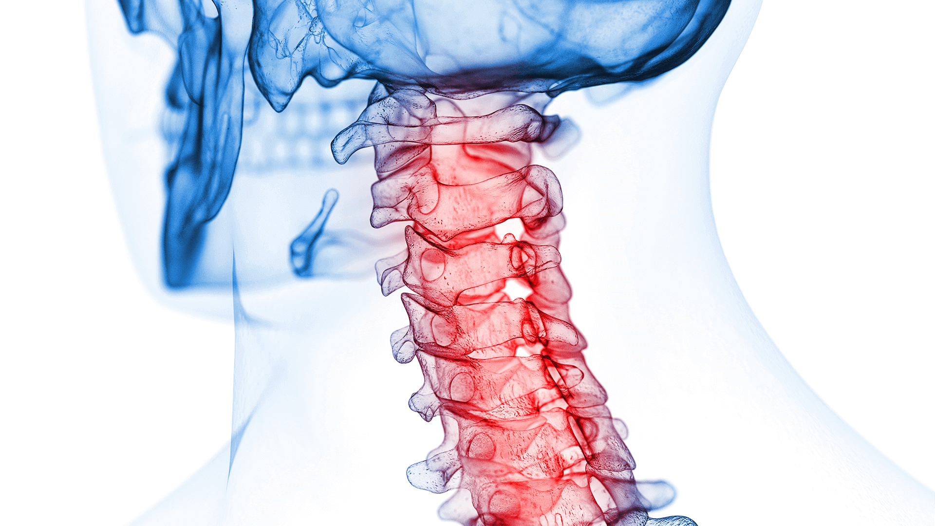 Cervical Laminoplasty vs Cervical Laminectomy: What’s the Difference?