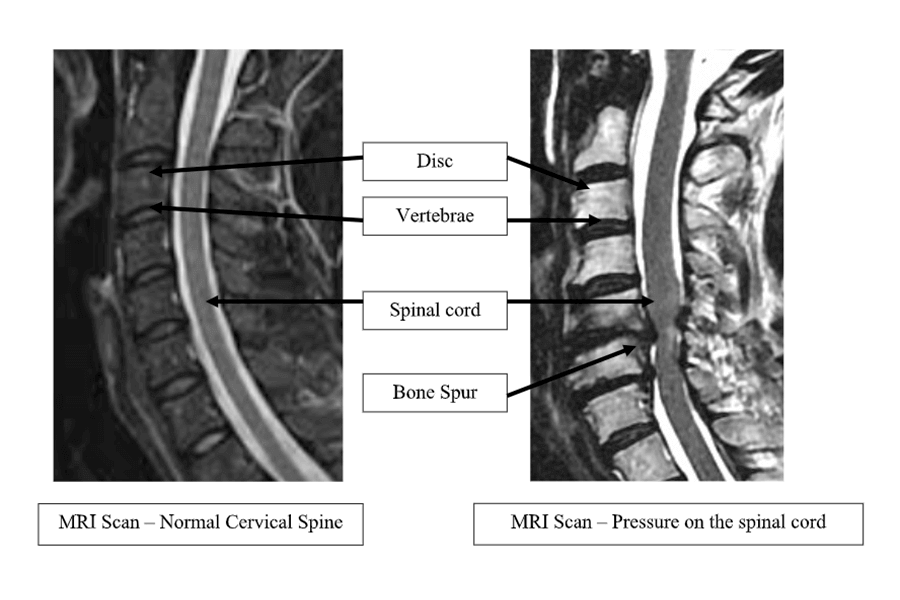 Cervical Spondylotic Myelopathy Mri