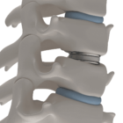 Is Cervical Artificial Disc Replacement Right for Me?