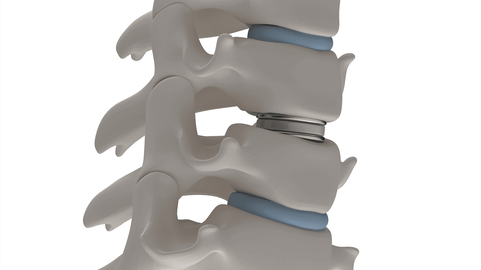 Is Cervical Artificial Disc Replacement Right for Me?