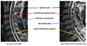 Normal neck vs neck with herniated disc