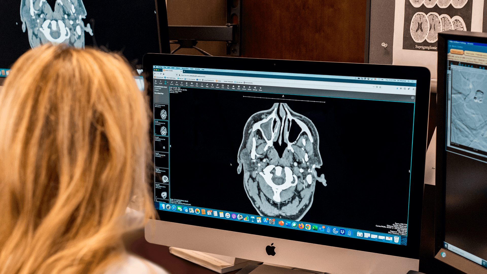 Subdural Hematoma Treatment