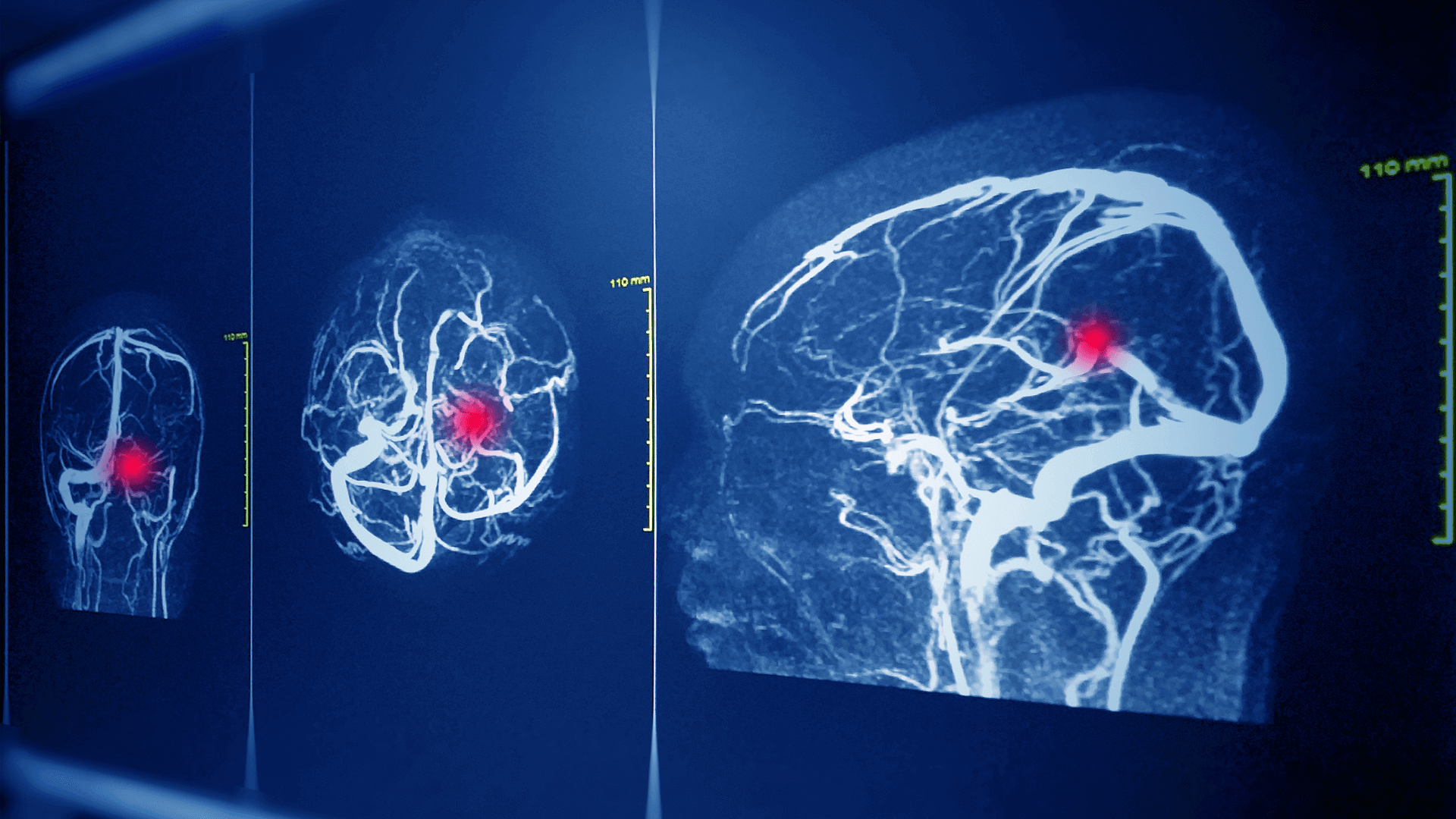 What is brain aneurysm surgery? A guide for you