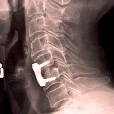 X-tay after ACDF treatment