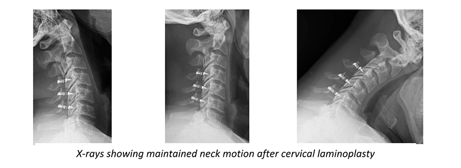 X-rays showing maintained neck motion after cervical laminoplasty