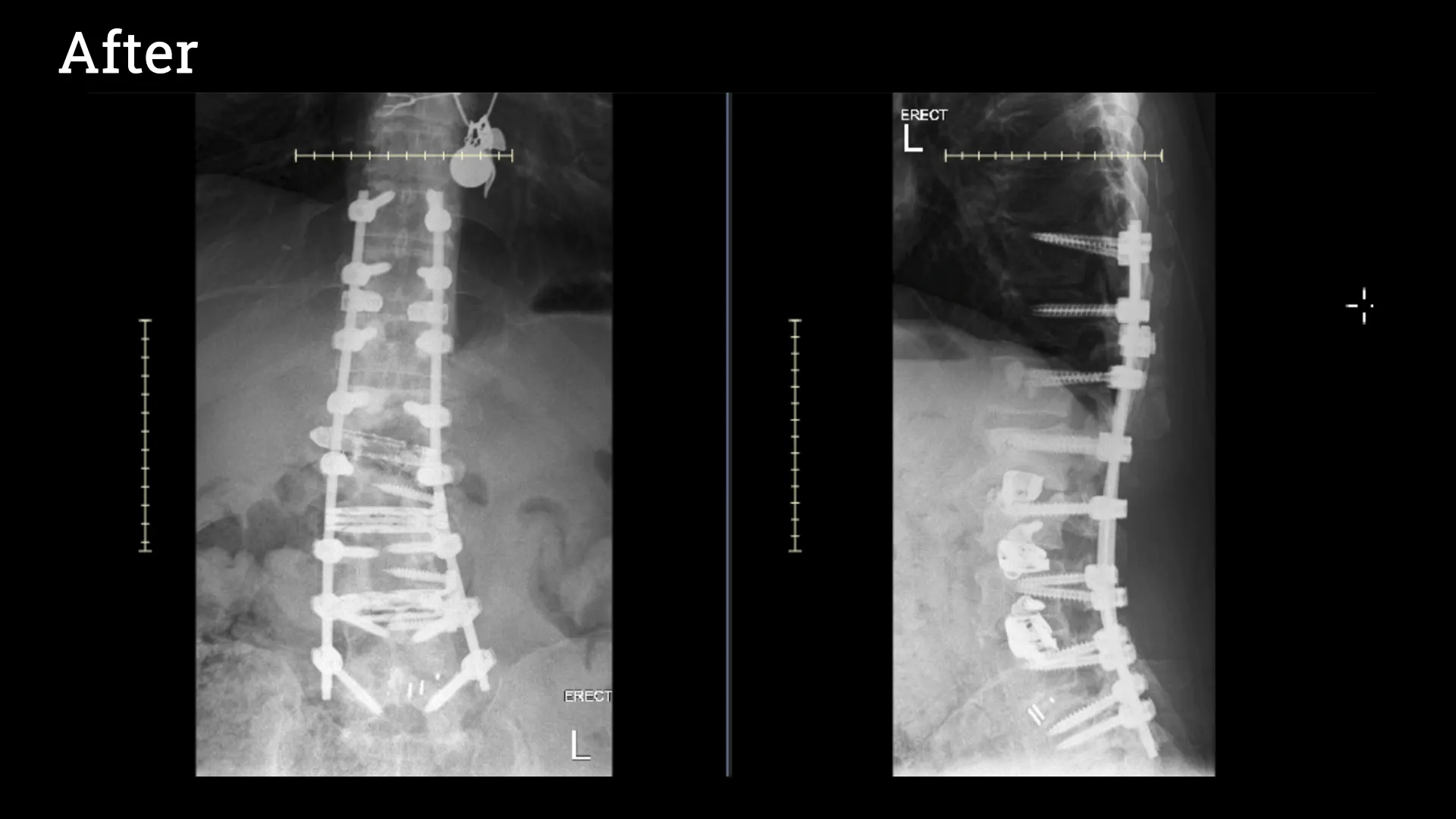 After spine surgery