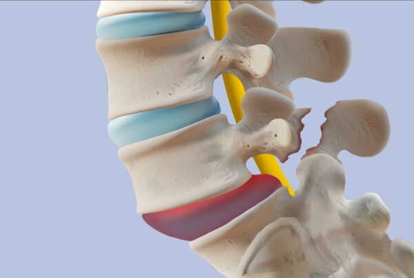 Human spondylolisthesis anatomy medical illustration.
