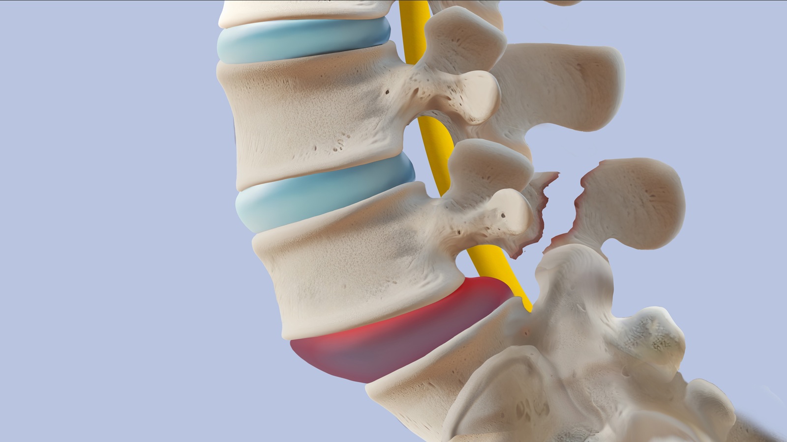 Pars Defect of the Lumbar Spine: What to Know
